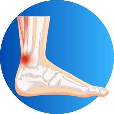 Understanding about Achilles Tendonitis Icon Image