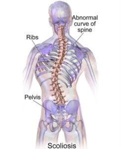 best back brace for scoliosis